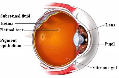 Detached Retin